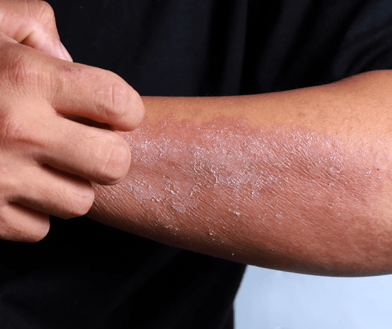 Skin disease treatment